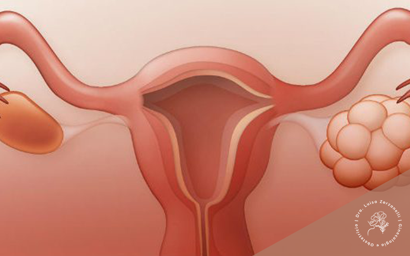 O que é a Síndrome dos Ovários Policísticos: Entenda os principais sintomas e como tratar